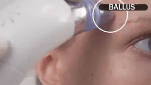 PoreClean Pro - Blackhead Remover Vacuum
